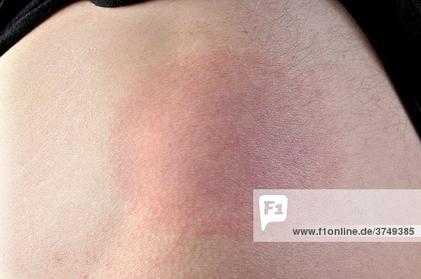 47+ Hautausschlag nach zeckenbiss bilder , Hautausschlag, Wanderröte (Erythema migrans), nach einem Zeckenbiss