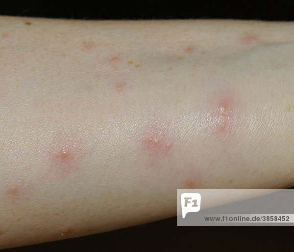 30++ Geschwuer am after bilder , Wheals and nodules on a forearm after an allergic reaction to harvest