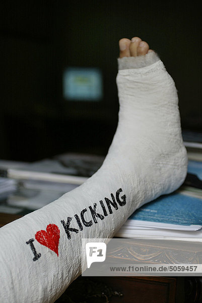 Gebrochenen Fuß mit Gips Lizenzpflichtiges Bild Bildagentur