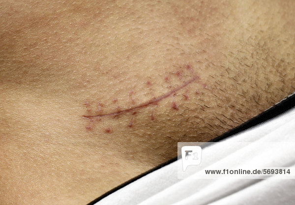 46++ Narben nach brust op bilder , Narbe nach Operation eines Leistenbruchs bei einem Mann Rights