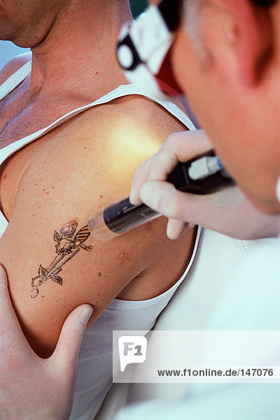 Mann mit entferntem Tattoo