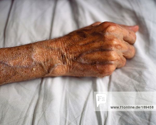 Elderly arm