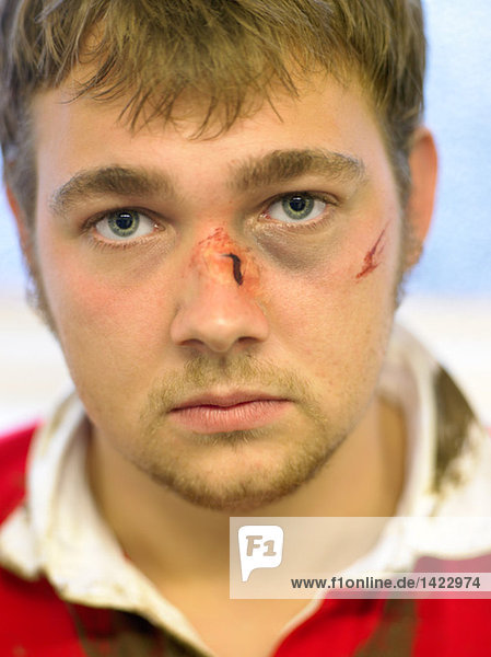 Bruised and cut rugby player