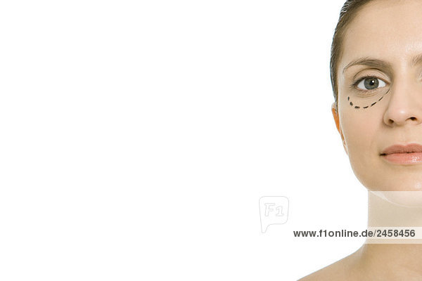 Frau mit plastischen Operationsmarkierungen unter dem Auge  Blick in die Kamera  beschnitten