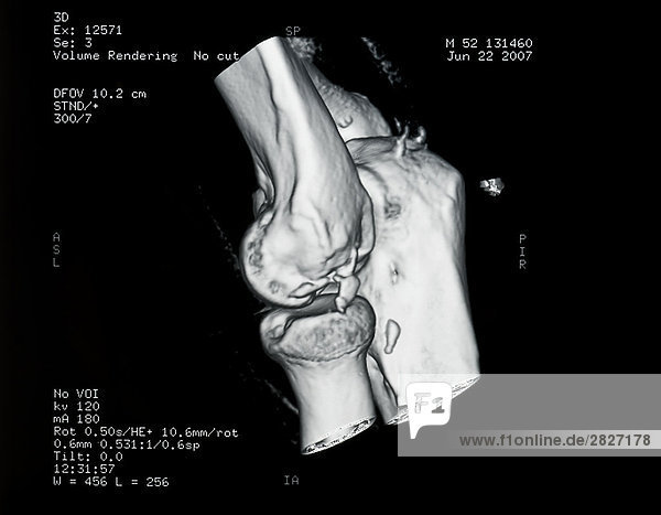 Nahaufnahme der Röntgenbild des menschlichen Knochen