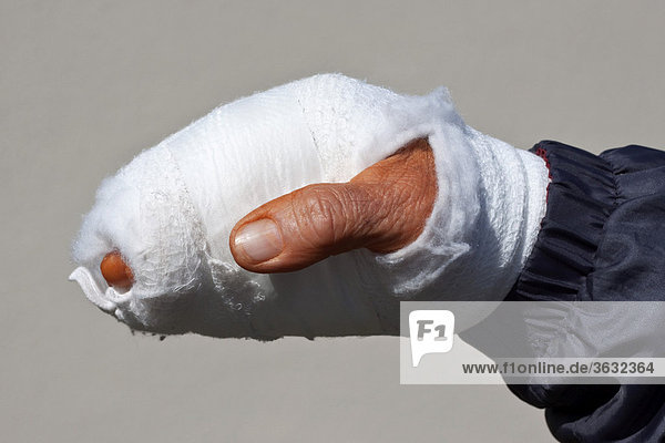 Frisch operierte verbundene Hand nach einem Arbeitsunfall  die Haut noch rötlich orange verfärbt durch Desinfektionsmittel