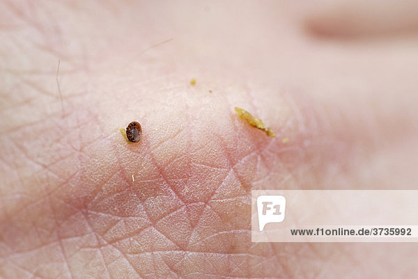 Tote Varroa Milbe (Varroa destructor varroa jacobsoni) auf Handrücken