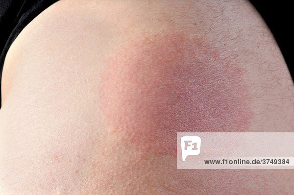 Hautausschlag  Wanderröte (Erythema migrans)  nach einem Zeckenbiss