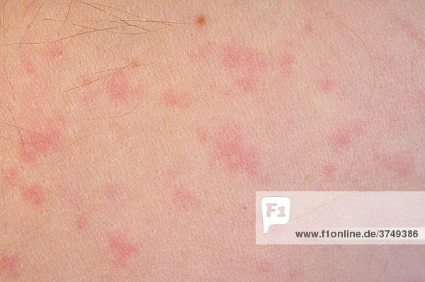 Allergischer Hautausschlag bei einer Penicillin Unverträglichkeit
