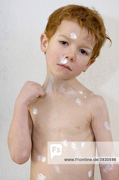 Child with chickenpox varicella zoster infection