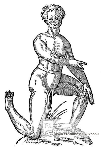 Holzschnitt  Homo pedibus auersis  Mann mit verdrehten Beinen und Füßen  Aldrovandi  Historia Monstrorum  1642  Renaissance