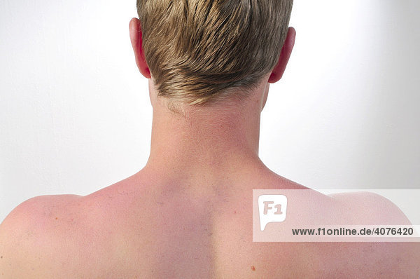 Jugendlicher mit Sonnenbrand auf dem Rücken