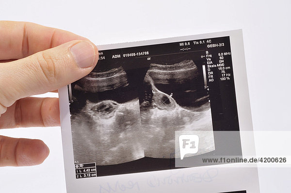 Hand hält Ultraschallfoto mit einer Zyste an einem Eierstock