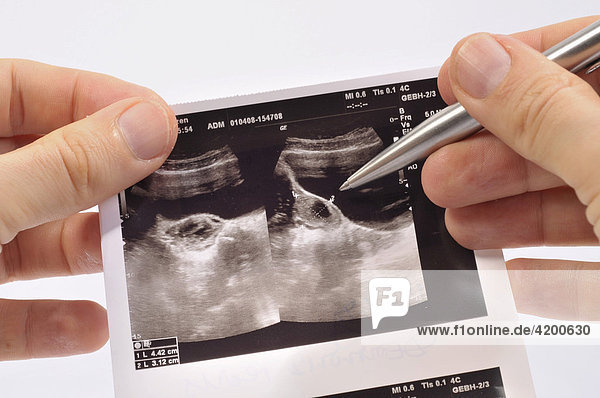 Hände halten Ultraschallfoto mit einer Zyste an einem Eierstock