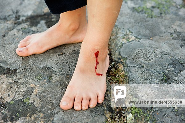 Niedrige Abschnitt Person mit Blutungen Fuß