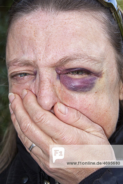 45jährige Frau mit blauem Auge  Hämatom  Bluterguss  Blutung im Lidbereich des Auges  Symbolbild für häusliche Gewalt