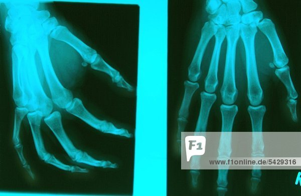Röntgenbild einer Hand ohne Befund