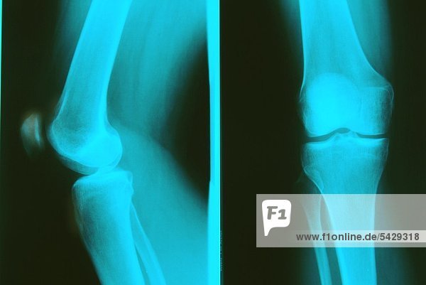 Röntgenbild eines Knies ohne Befund
