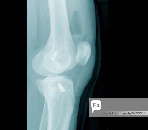 Röntgenbefunde einer chirurgischen Praxis . Das Röntgenbild zeigt Knie nach Kreuzband - OP
