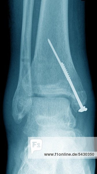 Röntgenfoto einer chirurgischen Praxis . Das Röntgenbild zeigt : Verschraubter Innenknoechelbruch .