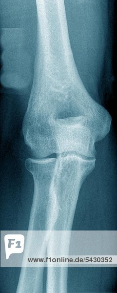 Röntge - Foto einer chirurgischen Praxis . Das Röntgenbild zeigt Ellenbogen o .B .