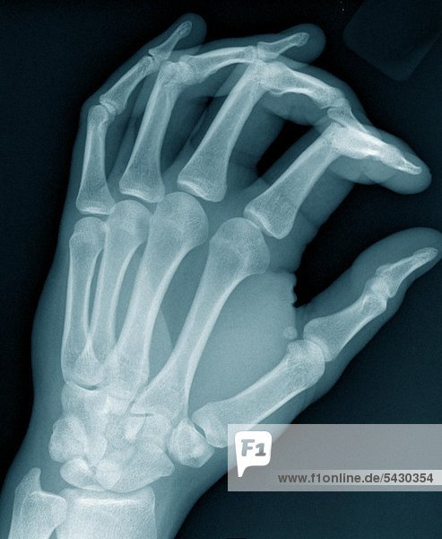 Röntgenbefunde einer chirurgischen Praxis . Das Röntgenbild zeigt : Hand ohne Befund .