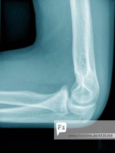 Röntgen-Foto einer chirurgischen Praxis . Das Röntgenbild zeigt : Ellenbogen o .B .