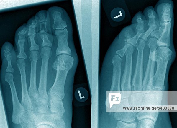Röntgenfoto einer chirurgischen Praxis . Das Röntgenbild zeigt : Vorfuß o .B .