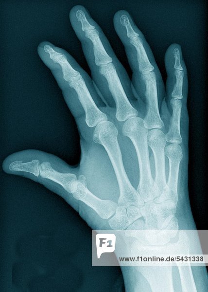 Röntgenfotos einer chirurgischen Praxis. Hand ohne Befund