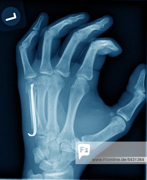 Röntgenfotos einer chirurgischen Praxis. Handbruch des Mittelhandknochens