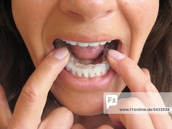 Bruxismus - bruxism - das meist unbewusste nächtliche Knirschen mit den Zähnen - durch das Knirschen mit den Zähnen treten in den meisten Fällen Fehlbelastungen der Zähne bzw. Zahngruppen oder Kiefergelenksbeschwerden auf - um eine Entlastung der Zähne und eine Gelenkschonung bei Kieferarthropathie zu erreichen wird eine individuell angepasste Kunststoffplatte   Knirscherschiene   Aufbissbehelf ( Okklusionsschiene oder Relaxierungsschiene ) für den Patienten angefertigt - diese sollte vorwiegend nachts getragen werden - Ursachen können psychischer ( Stress )   physischer ( Skeletterkrankungen ) oder neurologischer ( MS Multiple Sklerose ) Natur sein - Frau setzt Knirscherschiene in den Unterkiefer ein mund
