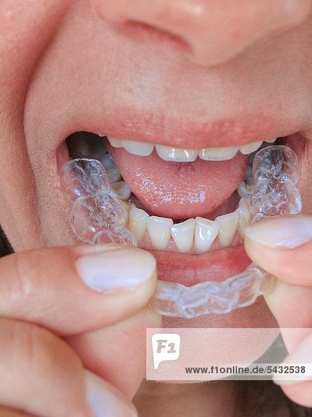 Bruxismus - bruxism - das meist unbewusste nächtliche Knirschen mit den Zähnen - durch das Knirschen mit den Zähnen treten in den meisten Fällen Fehlbelastungen der Zähne bzw. Zahngruppen oder Kiefergelenksbeschwerden auf - um eine Entlastung der Zähne und eine Gelenkschonung bei Kieferarthropathie zu erreichen wird eine individuell angepasste Kunststoffplatte   Knirscherschiene   Aufbissbehelf ( Okklusionsschiene oder Relaxierungsschiene ) für den Patienten angefertigt - diese sollte vorwiegend nachts getragen werden - Ursachen können psychischer ( Stress )   physischer ( Skeletterkrankungen ) oder neurologischer ( MS Multiple Sklerose ) Natur sein - Frau setzt Knirscherschiene in den Unterkiefer ein mund