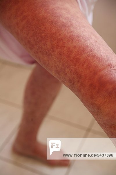 Beine einer Frau mit Penizillin - Allergie