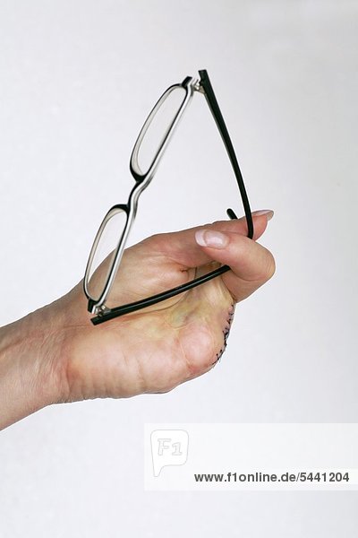Hand einer Frau  der drei Finger amputiert worden sind - sie hält mit zwei Finger eine Brille