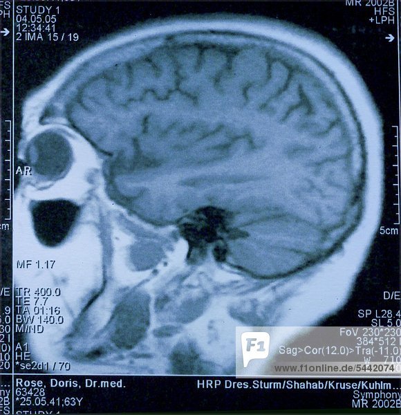 Computertomograph eines gesunden Gehirns
