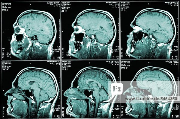 Magnet-Resonanz-Tomografie (MRT) 6 sechs Aufnahmen eines Kopfes Kernspintomografie