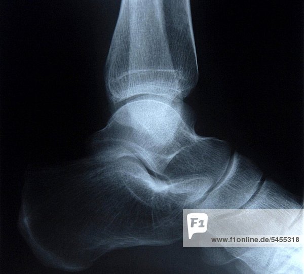 Röntgenbild eines Kniegelenks