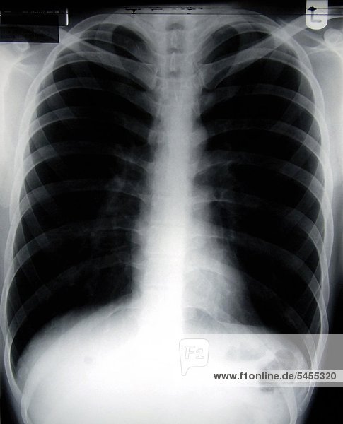 Röntgenbild eines weiblichen Brustkorbs