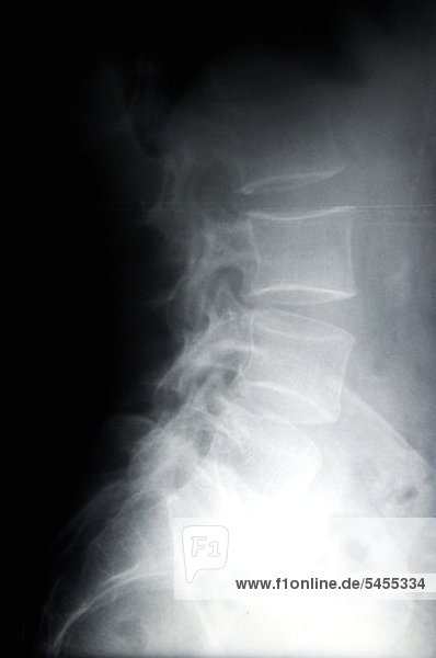 Röntgenbild einer weiblichen female cervical vertibrae