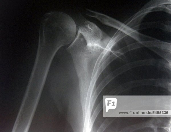 Röntgenbild einer weiblichen Schulter