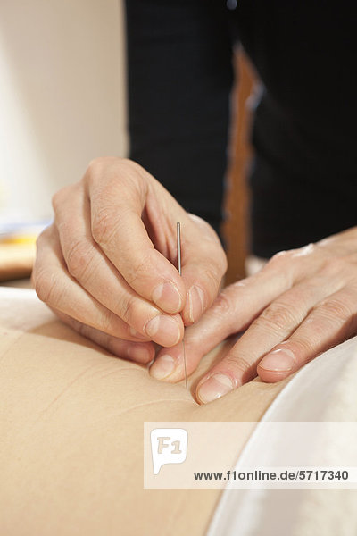 Acupuncture needle being placed  Traditional Chinese Medicine