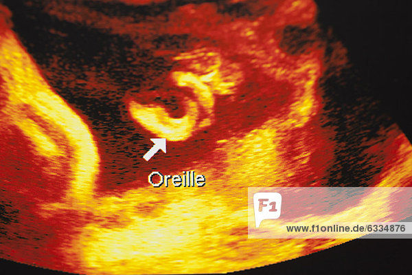 Ultrasound scan of developing fetus