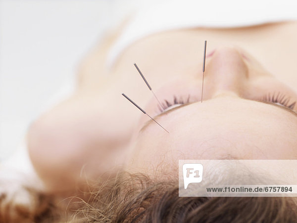 Frau empfangen Akupunktur
