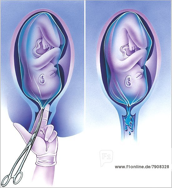 Öffnung der Fruchtblase im 9. Schwangerschaftsmonat