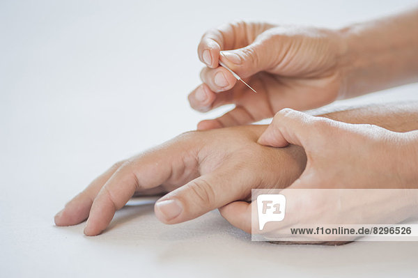 Traditionelle Chinesische Medizin  TCM  Akupunktur  Hand mit Akupunkturnadel während der Behandlung