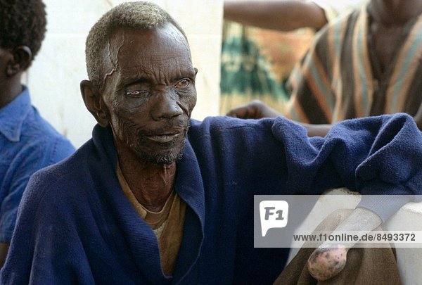 Patient suffering from leprosy attending a clinic in The Gambia