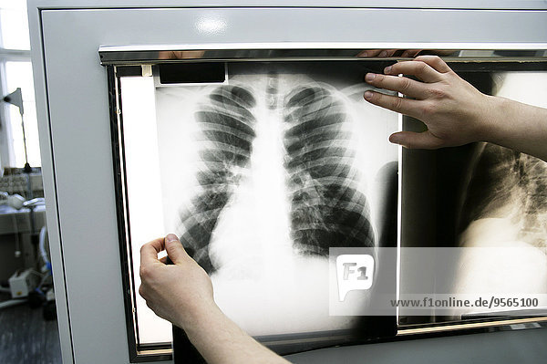 Person  die das Röntgenbild der Brust in den Leuchtkasten hält.