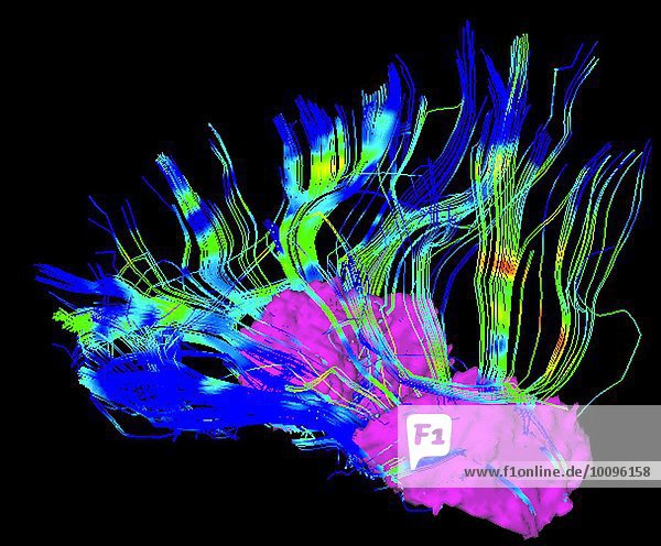 Verbindungen zwischen Putamen und Frontallappen im Gehirn eines Parkinson-Patienten