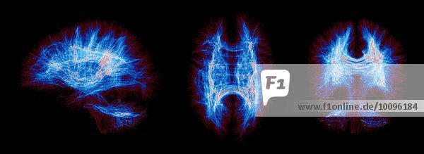 Sagittale  axiale  koronale Ansichten eines vollständigen menschlichen Gehirns. Die Bilder werden durch die Faserdichte eingefärbt.