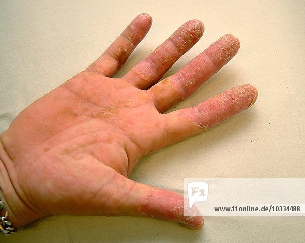 Hautarztpraxis  Hand mit Ekzem